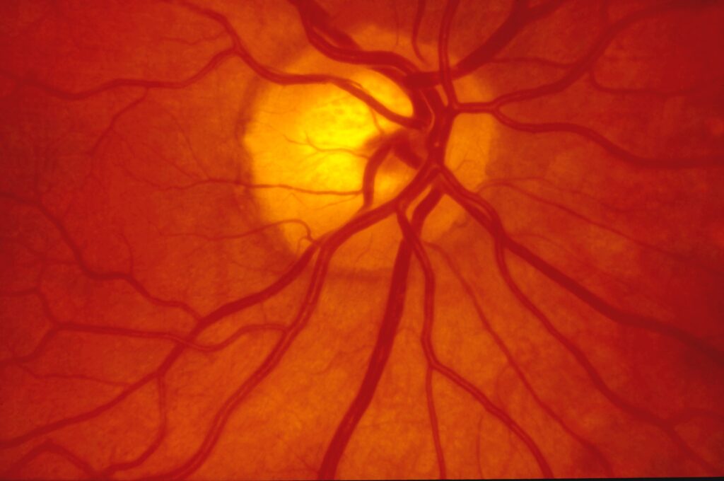 Diabetic Retinopathy in Vijaynagar